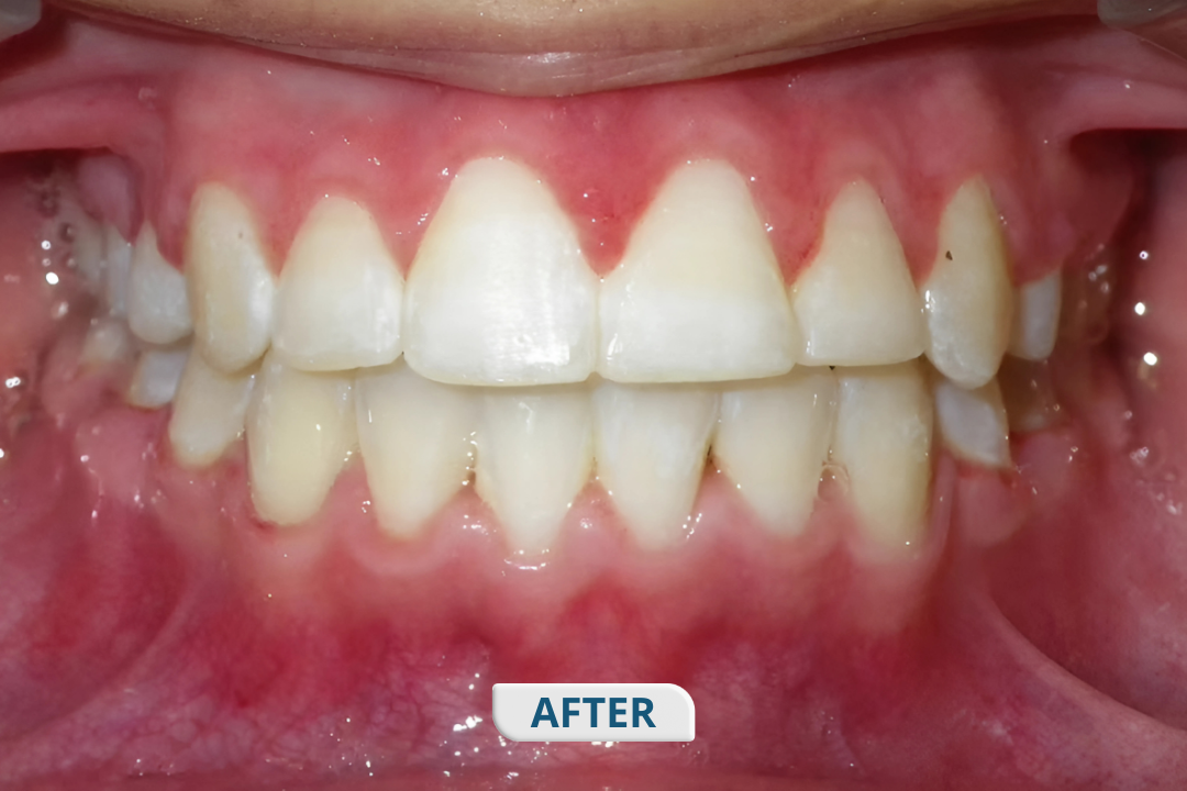After treatment at Namira Oro Dental Care